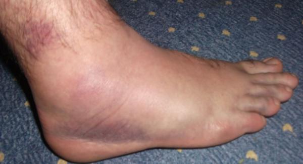 Name:  Foot.jpg
Views: 944
Size:  22.9 KB